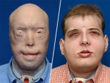 Trasplante de cara: presentan el caso ms complejo