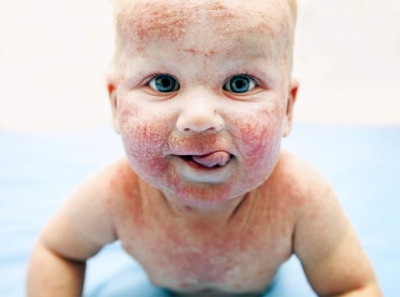 Dermatitis atpica: causas, efectos y estrategias para limitar su evolucin